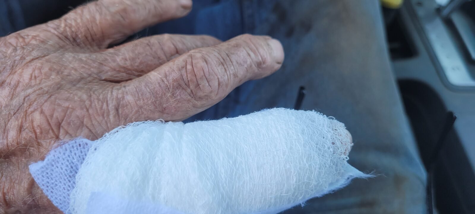 Bandaged finger from chainsaw mishap.