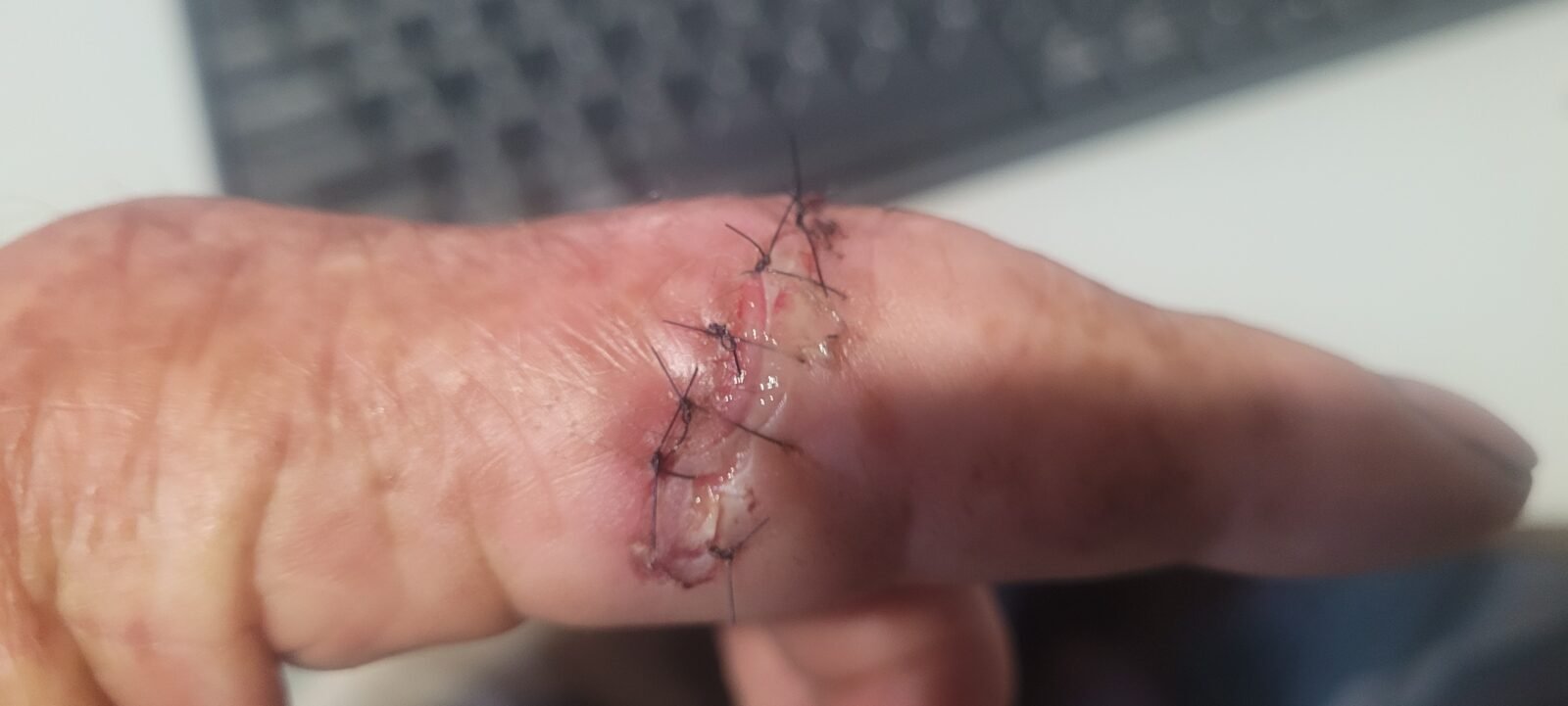 Getting my chainsaw injury stitched up.
