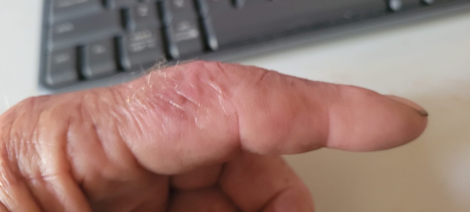 Finger healed nicely.
